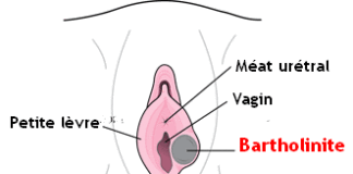 Bartholinite Dr SKHIRI gynecologue