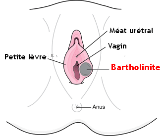 Bartholinite Dr SKHIRI gynecologue