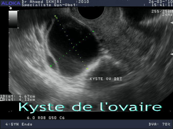 Kyste de l’ovaire - Dr Ahmed SKHIRI