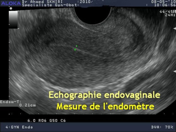 Echographie gyneco endometre Dr SKHIRI