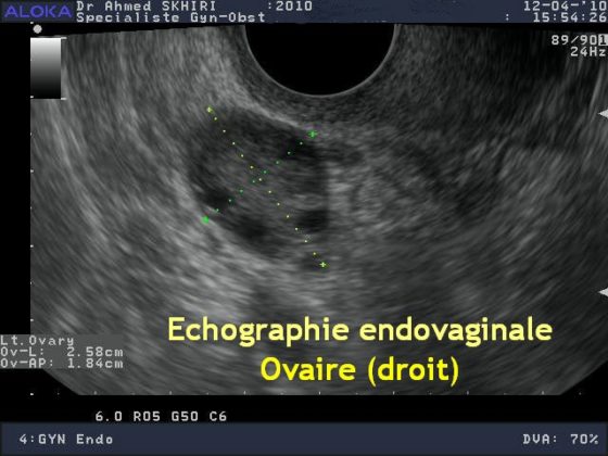 Echographie gyneco ovaire Dr SKHIRI