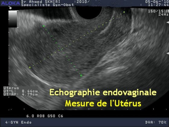 Echographie gyneco uterus Dr SKHIRI