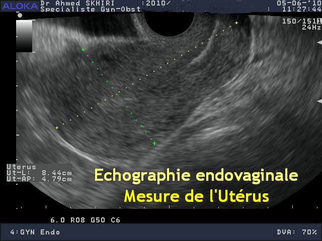 Echographie gynécologique - Dr Ahmed SKHIRI