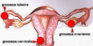 Grossesse extra uterine Dr SKHIRI gynecologue Tunis