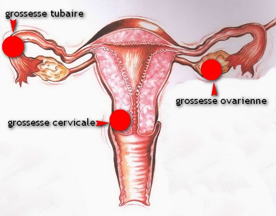 Grossesse extra uterine Dr SKHIRI gynecologue Tunis