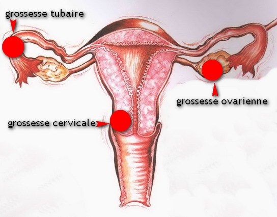 Grossesse extra-utérine - Dr Ahmed SKHIRI