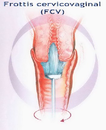 frottis cervicovaginal FCV Dr SKHIRI gynecologue