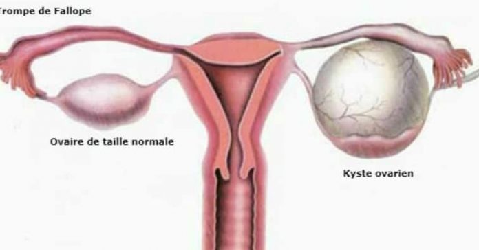 Le kyste de l’ovaire est une tumeur à composante liquidienne qui se développe aux dépens de l’ovaire