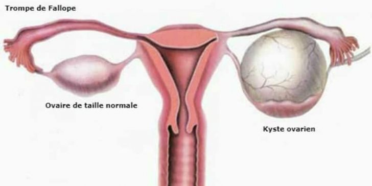 Le kyste de l’ovaire est une tumeur à composante liquidienne qui se développe aux dépens de l’ovaire