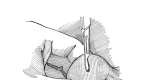 Biopsie testiculaire 3