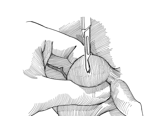 Biopsie testiculaire 3