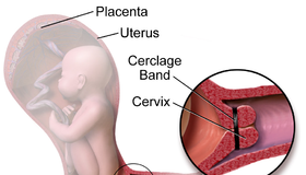 Cervical Cerclage