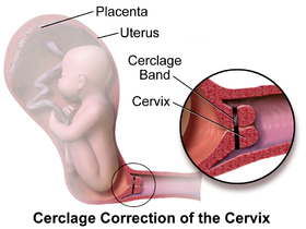 Cervical Cerclage