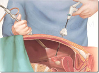 La plupart des interventions gynécologiques peuvent être réalisées par coelioscopie.
