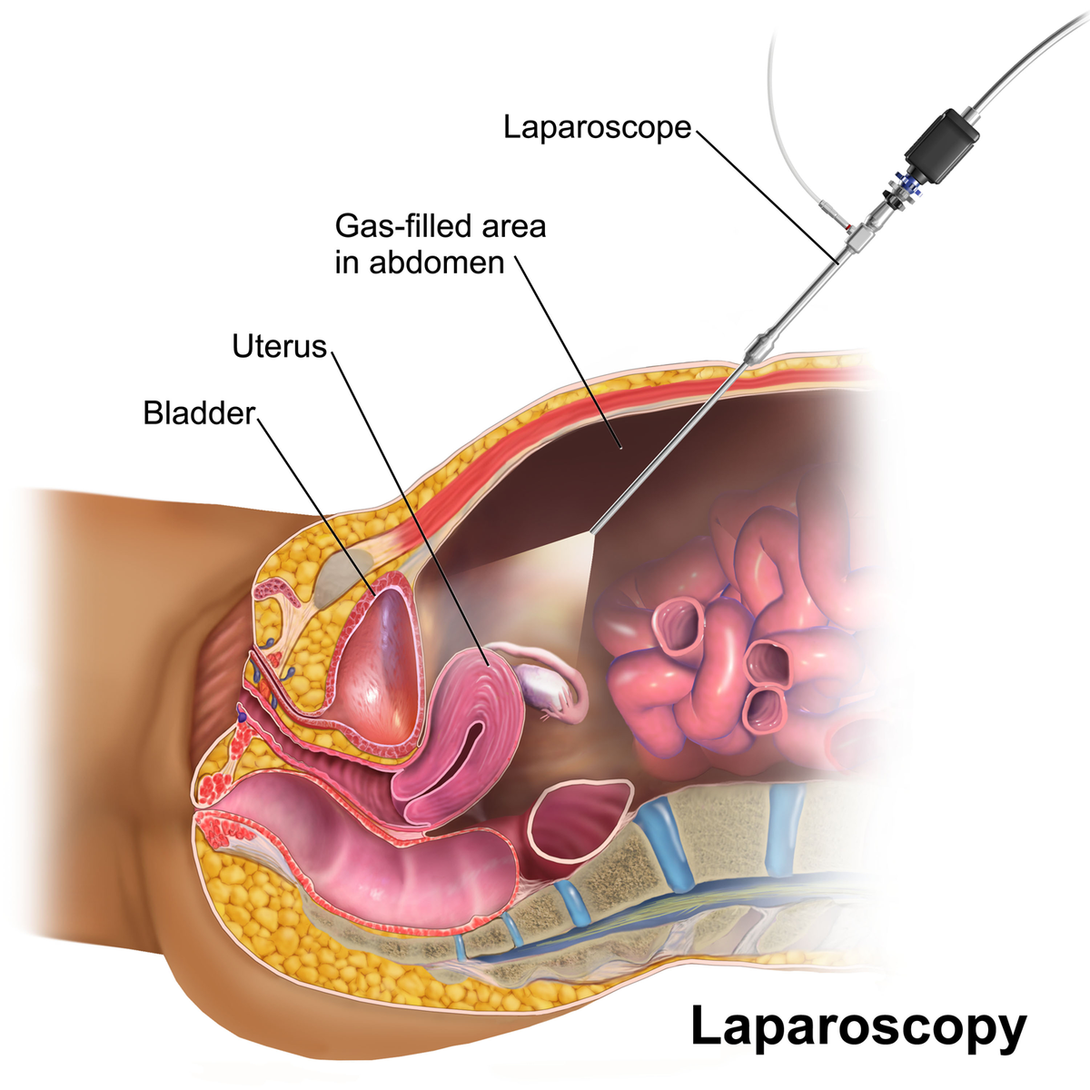 La cœlioscopie opératoire en Tunisie, permet de traiter une grossesse extra-utérine, un kyste de l'ovaire, une endométriose ou des adhérences.