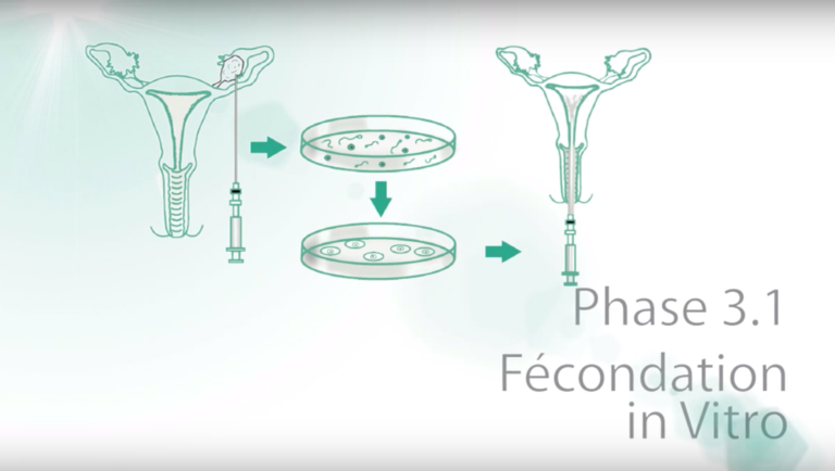 Fécondation In vitro