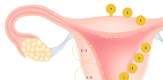 classification figo fibromes 2