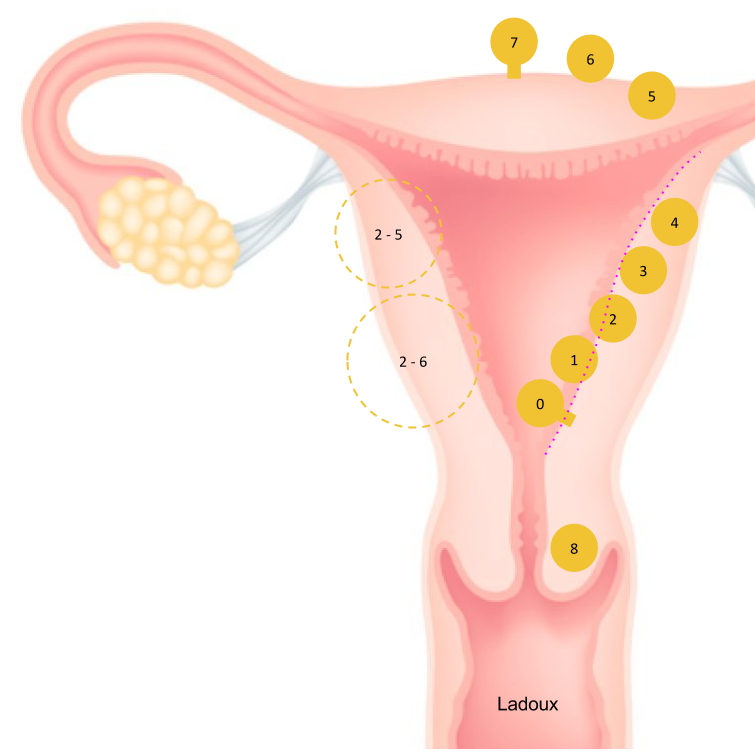 classification figo fibromes 2