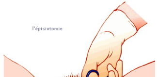 episiotomie