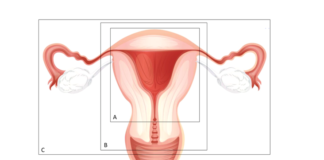 hysterectomie