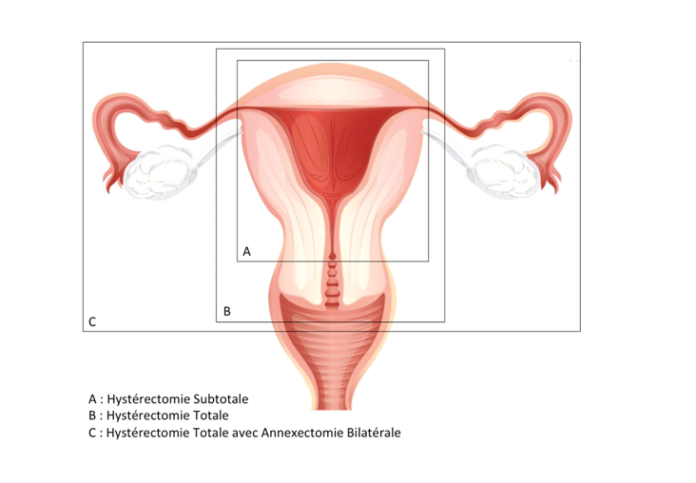 hysterectomie