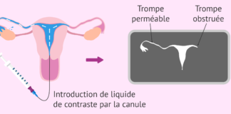 resultat de lhysterosalpingographie et obstruction tubaire