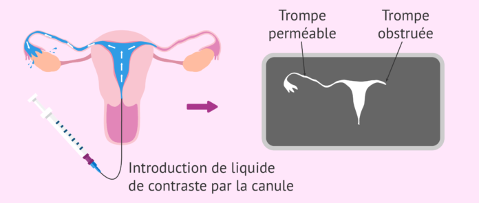 resultat de lhysterosalpingographie et obstruction tubaire