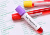 test trisomie 21