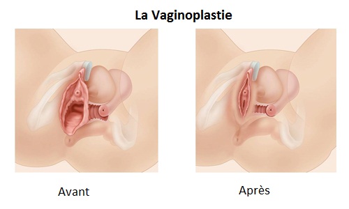 vaginoplastie en tunisie dr ahmed skhiri 1