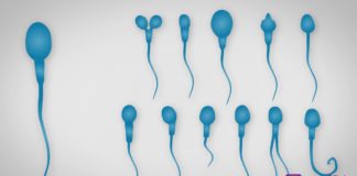Teratospermie