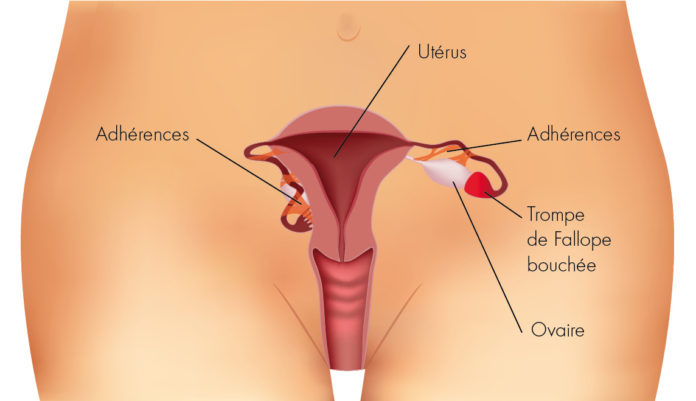 imperméabilité des trompes