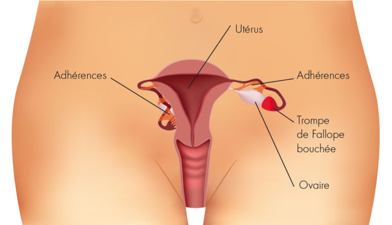 imperméabilité des trompes