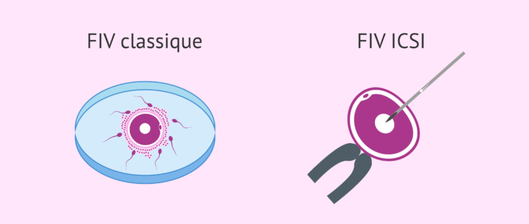 Differences entre FIV classique et ICSI