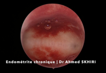 endométrite chronique hystéroscopie Dr Ahmed SKHIRI