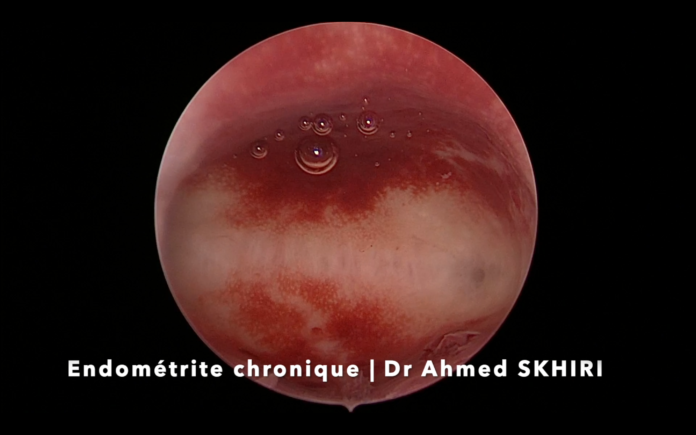 endométrite chronique hystéroscopie Dr Ahmed SKHIRI