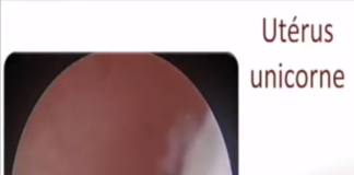 Uterus unicorne hysteroscopie Dr Ahmed SKHIRI 2017