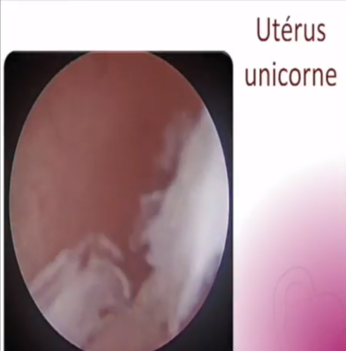 Uterus unicorne hysteroscopie Dr Ahmed SKHIRI 2017