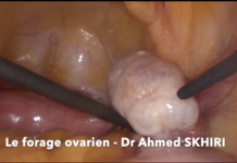 Le forage ovarien