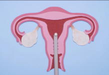 Fécondation in vitro étape par étape