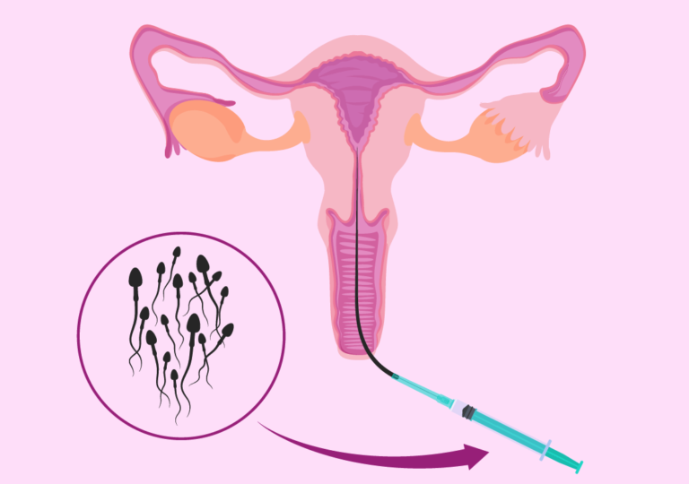 التلقیح داخل الرحم أو التلقیح الإصطناعي في تونس